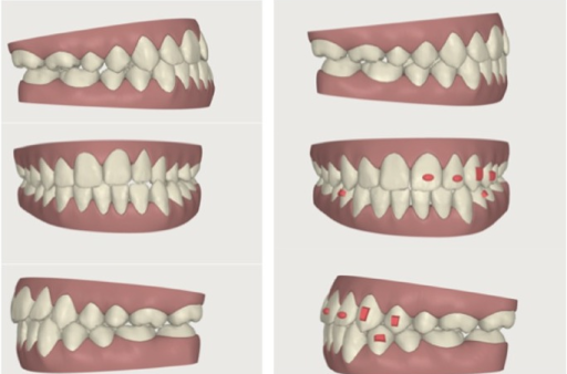best invisalign provider in bangalore